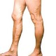 Варикозная болезнь нижних конечностей: основные симптомы, стадии и лечение