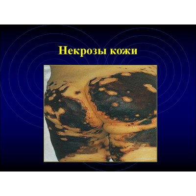 Некрозы кожи